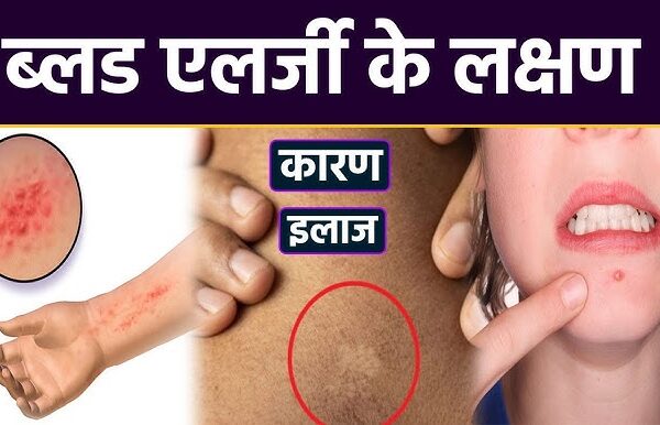 khoon mein allergy kyon hotee hai