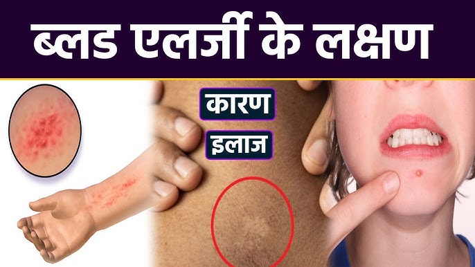 khoon mein allergy kyon hotee hai