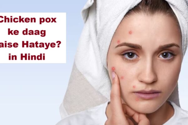 Chicken pox ke daag kaise hataye