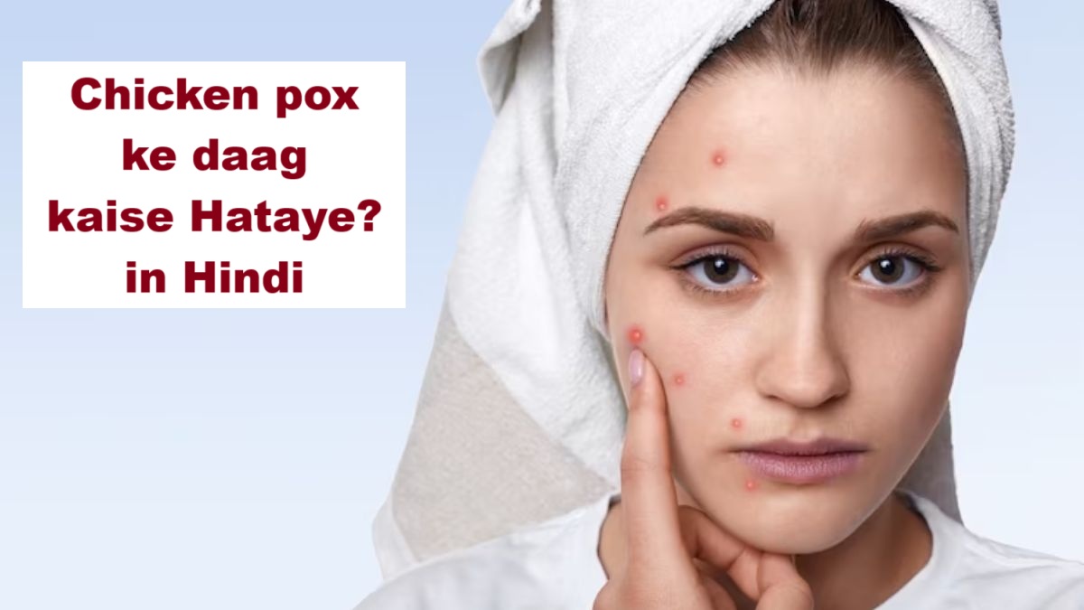 Chicken pox ke daag kaise hataye