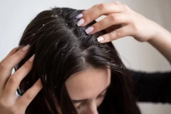 Dandruff kaise hataye​