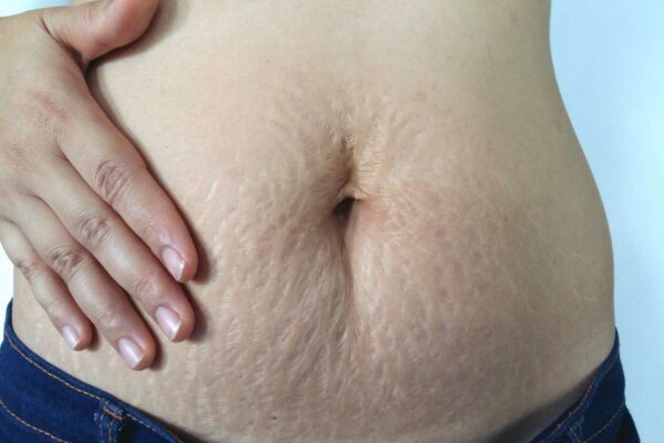 Stretch marks kaise hataye
