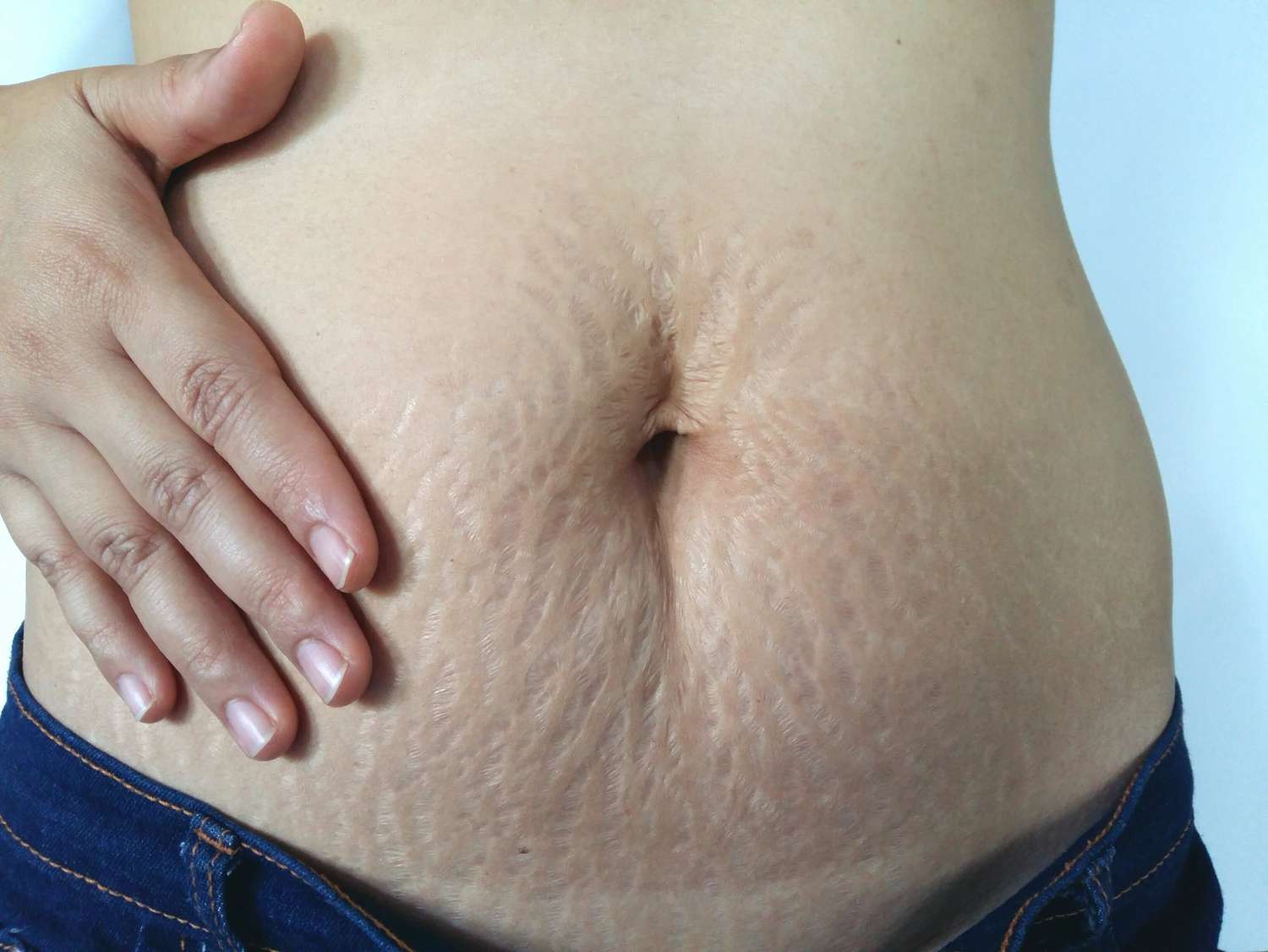 Stretch marks kaise hataye